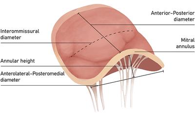Direct Percutaneous Mitral Annuloplasty in Patients With Functional Mitral Regurgitation: When and How